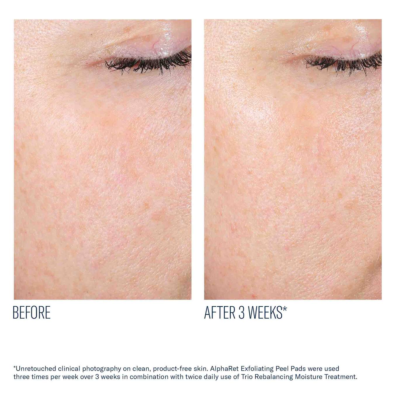 Alpharet Exfoliating Peel Pads